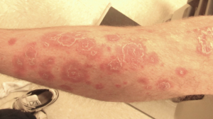 22-Year-Old Male with Scaly Red Plaques
