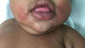 3-Month-Old Female with Facial Rash