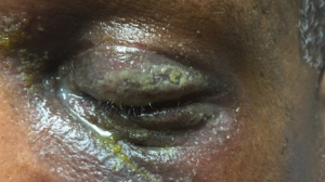49-Year-Old Male with Bilateral Eyelid Erythema