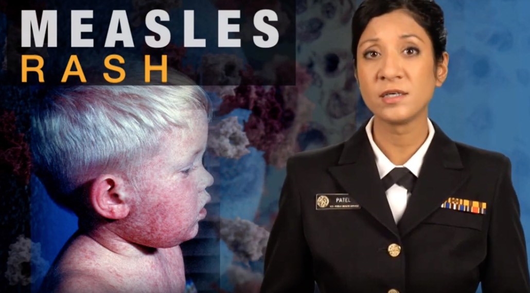 Measles Clinical Features and Diagnosis Thumbnail