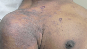 Thumbnail image for 59-Year-Old Man with Generalized Body Rash. Click to play.