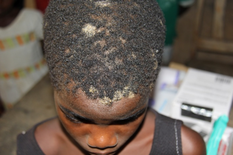 Spot Baldness Alopecia Areata  Causes  Treatment