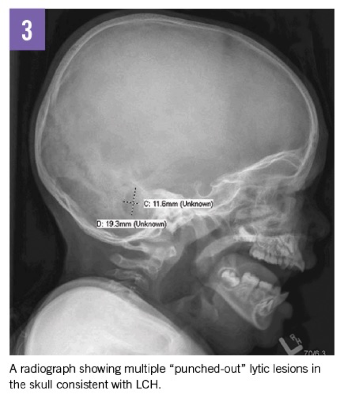 2 Year Old Female With Recalcitrant Diaper Dermatitis The Doctor S Channel