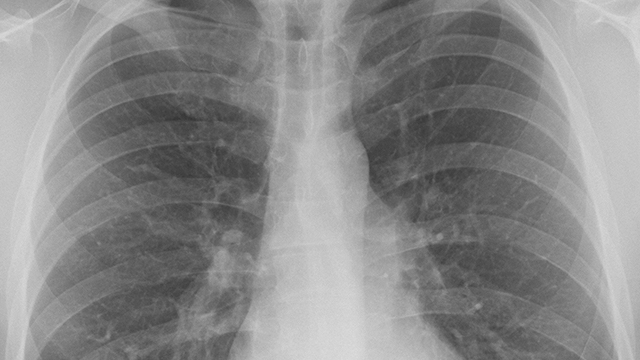 Nasser Hanna, MD, on Treatment for NSCLC Sans Mutations Thumbnail