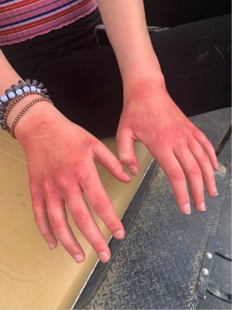 Irritant Contact Dermatitis Caused by Hand Sanitizer Use and