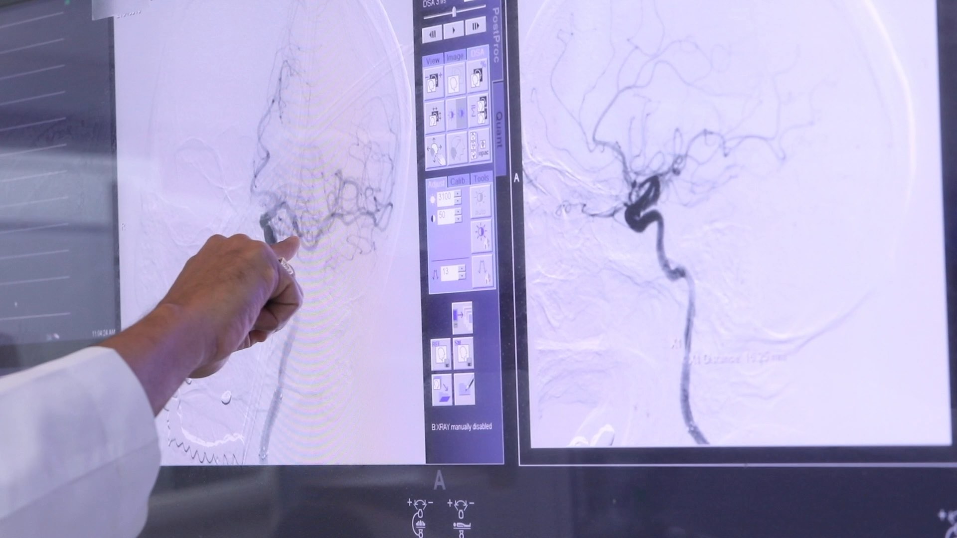 Mechanical Thrombectomy for LVO Stroke May Be “One of the Most Powerful Treatments in All of Medicine” Thumbnail