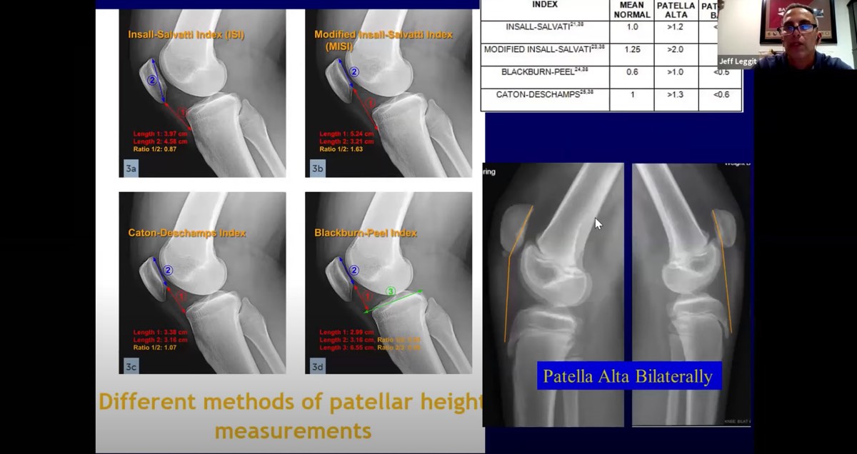 Anterior Knee Pain Thumbnail