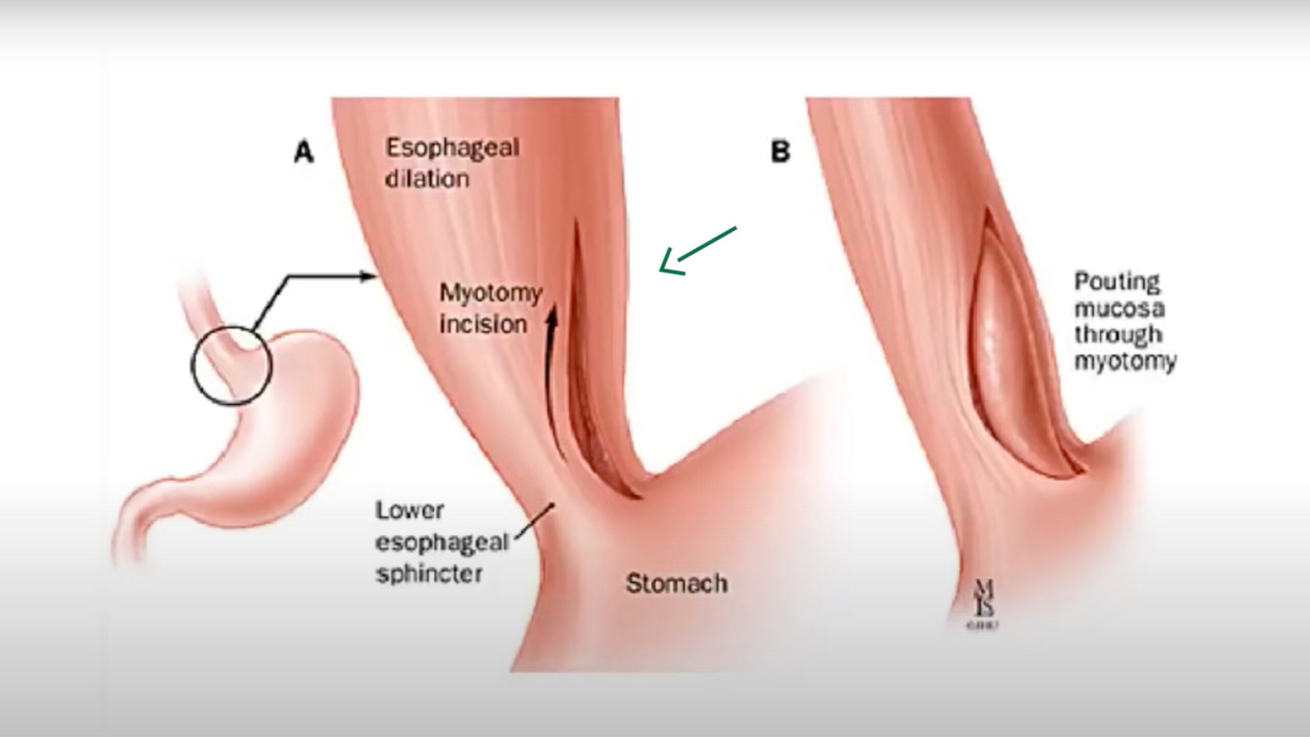 Achalasia: An Overview Thumbnail