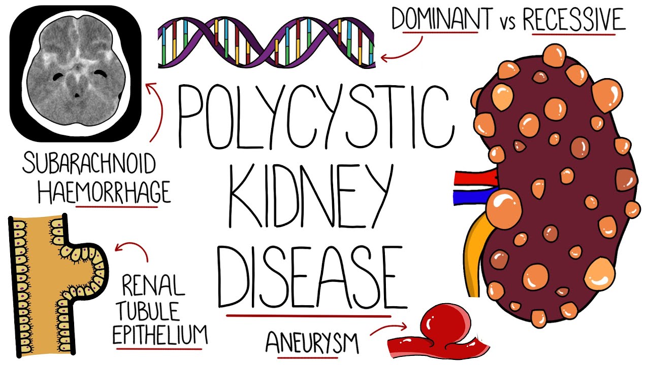 Polycystic Kidney Disease Explained Thumbnail