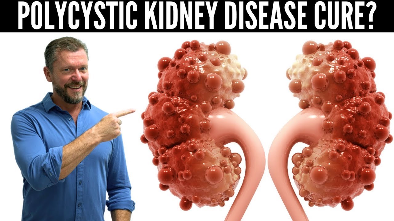 Polycystic Kidney Disease Breakthrough (New Research in PKD) – 2023 Thumbnail