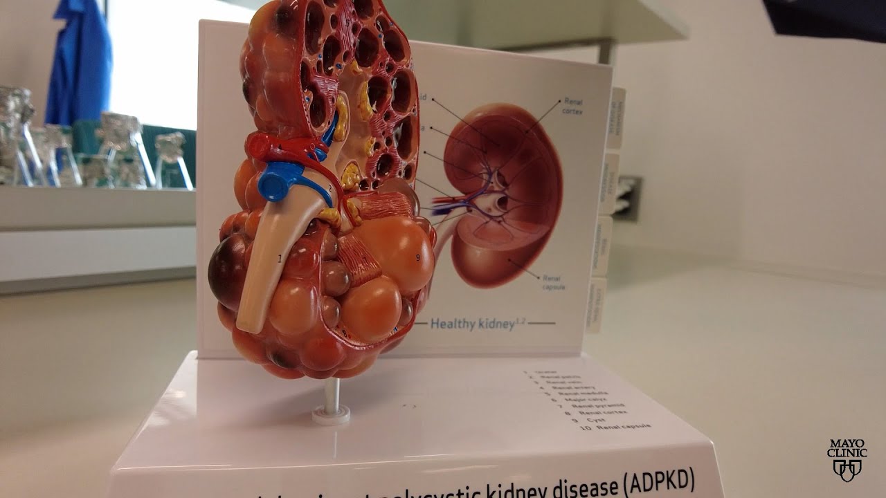 Mayo Clinic Minute: Using AI to Predict Kidney Failure in Patients with Polycystic Kidney Disease Thumbnail