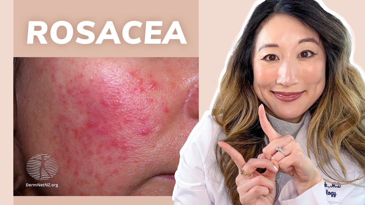 Dermatologist Guide to Rosacea – Treatments & Skincare Products Thumbnail