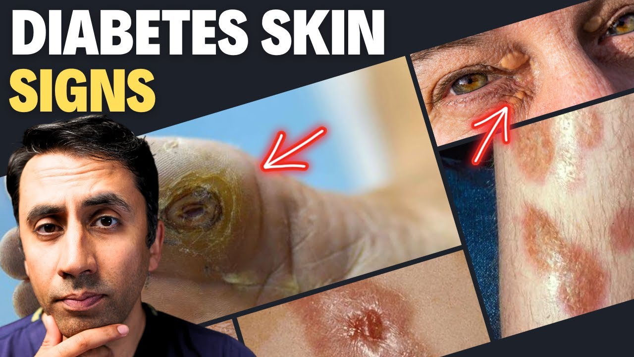 Doctor Explains 13 Skin Signs of Diabetes – Never Ignore These Symptoms Thumbnail