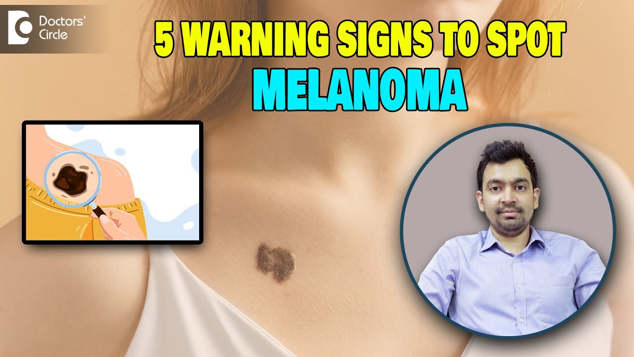 5 Warning Signs of Melanoma | Melanoma & Skin Cancer Awareness Month – Dr. Rajdeep Mysore Thumbnail