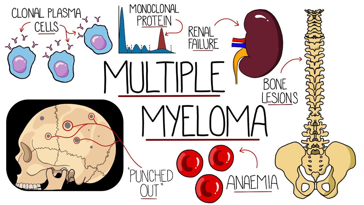 Understanding Multiple Myeloma (Multiple Myeloma Explained Clearly) Thumbnail