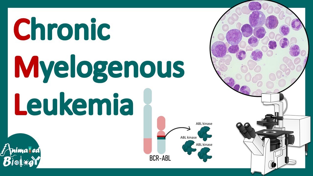 Chronic Myelogenous Leukemia (CML) | Pathology of CML | Diagnosis and treatment of CML | USMLE Thumbnail