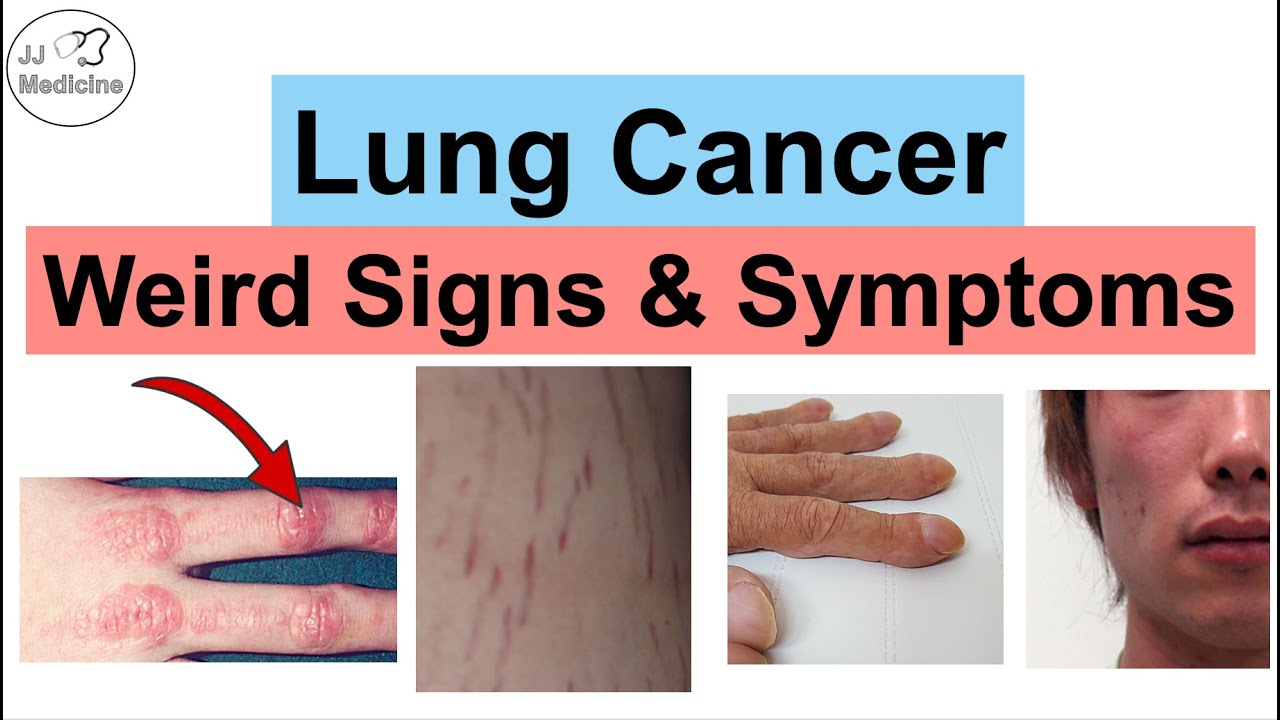 Lung Cancer Weird Signs and Symptoms | Paraneoplastic Syndromes of Lung Cancer Thumbnail