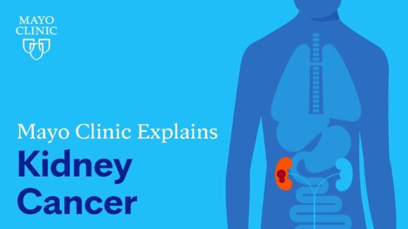 Mayo Clinic Explains Kidney Cancer The Doctor S Channel Short Mayo Clinic Explains Kidney Cancer The Doctor S Channel Short