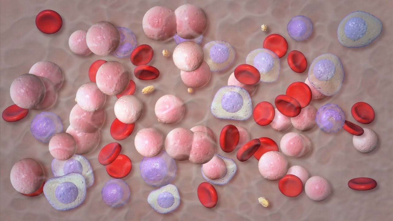 Mayo Clinic Minute – Advances in Multiple Myeloma Treatment Thumbnail
