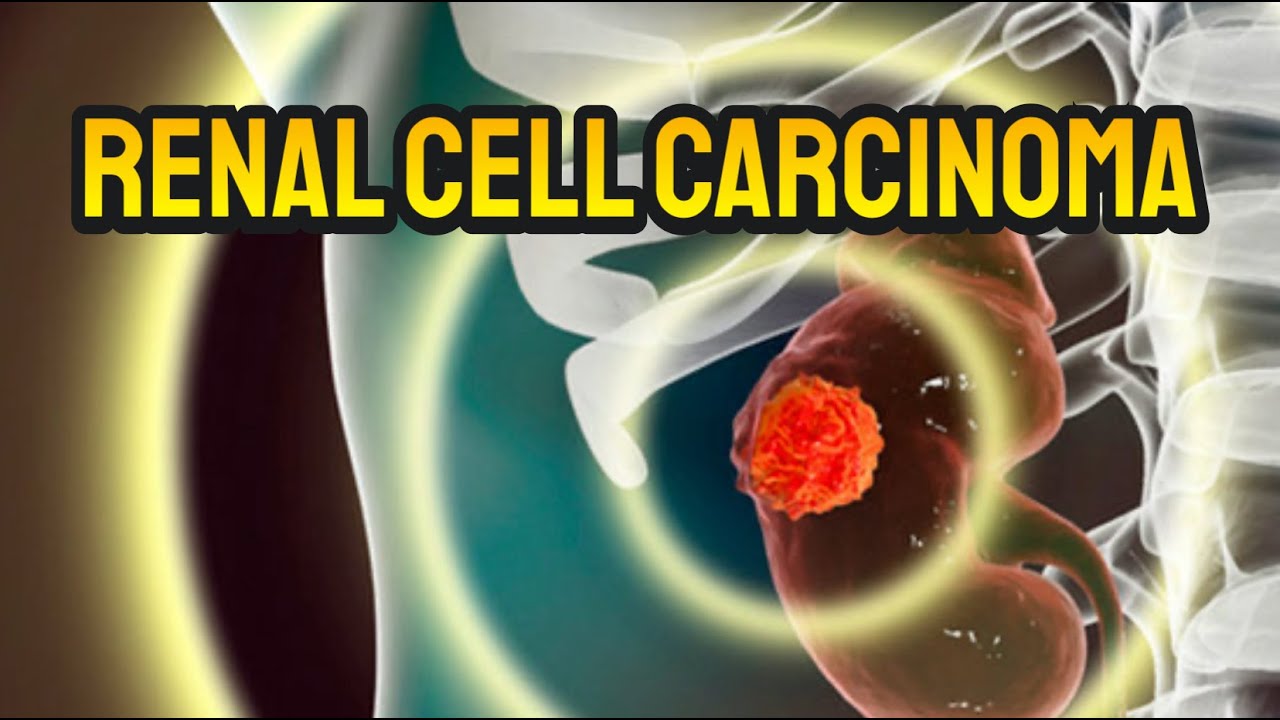 Renal Cell Carcinoma – Medical Review Thumbnail