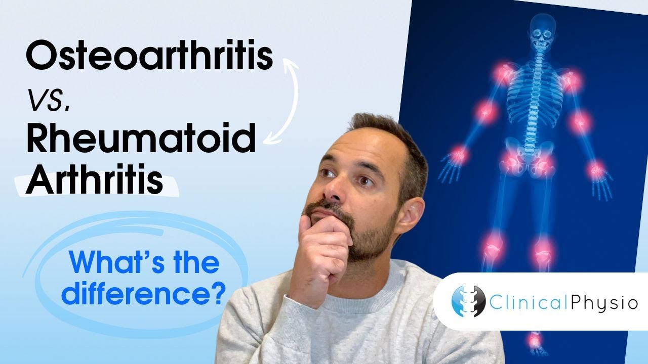 Osteoarthritis vs. Rheumatoid Arthritis | What’s the Difference? Thumbnail