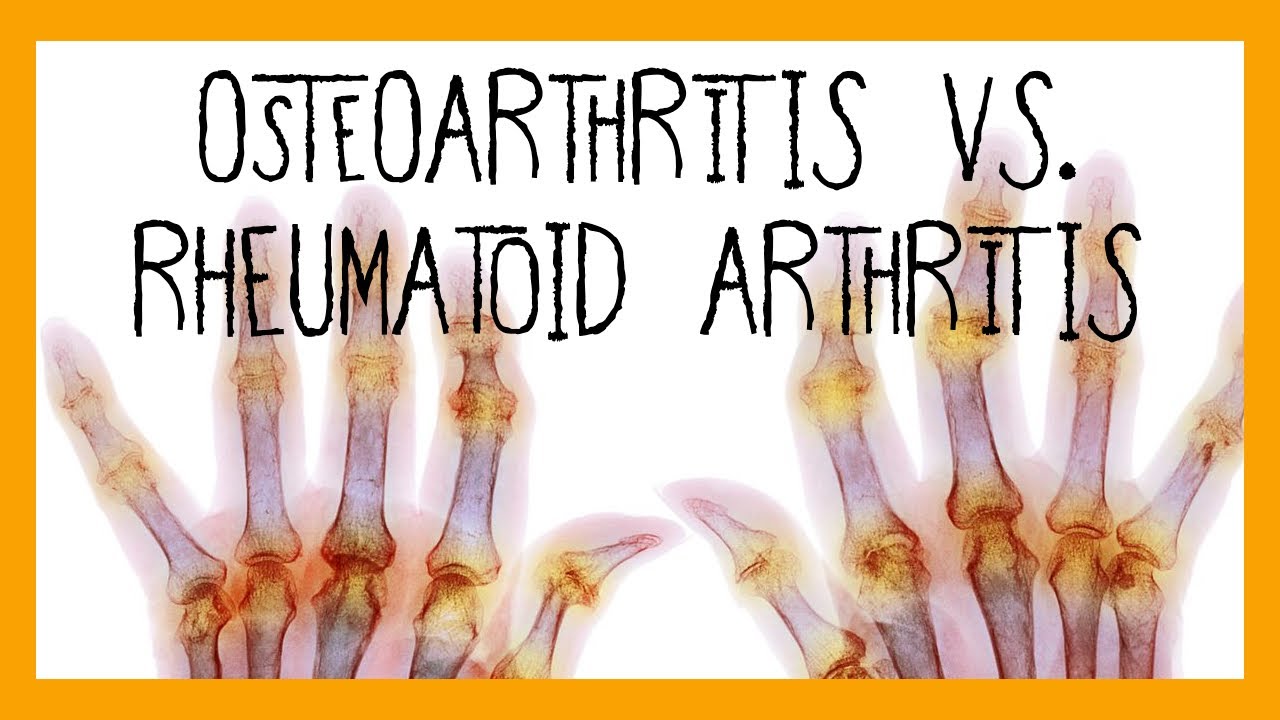 Osteoarthritis vs. Rheumatoid Arthritis Thumbnail