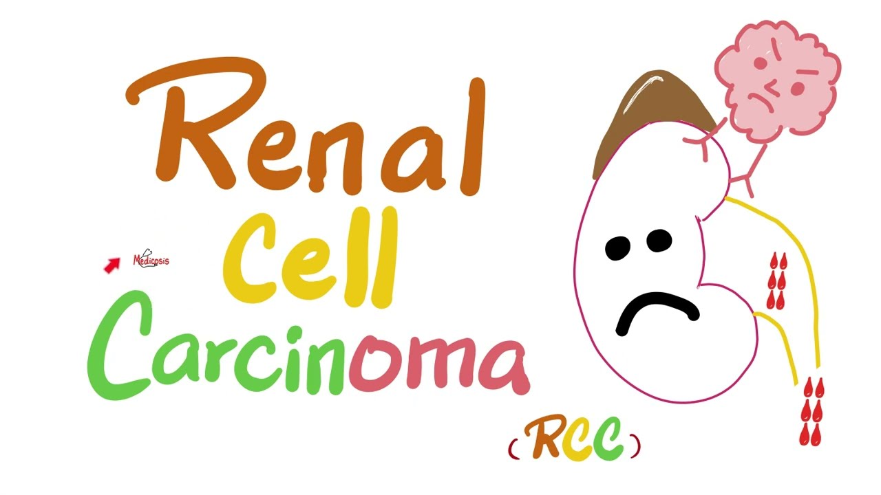 Renal Cell Carcinoma (RCC) – Kidney Tumors – Neoplasms – Renal Pathology – Nephrology Thumbnail