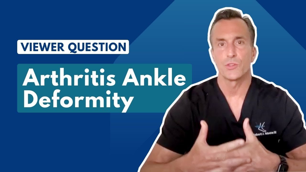 Rheumatoid Arthritis Ankle Deformity | Ask Dr. Moore Thumbnail