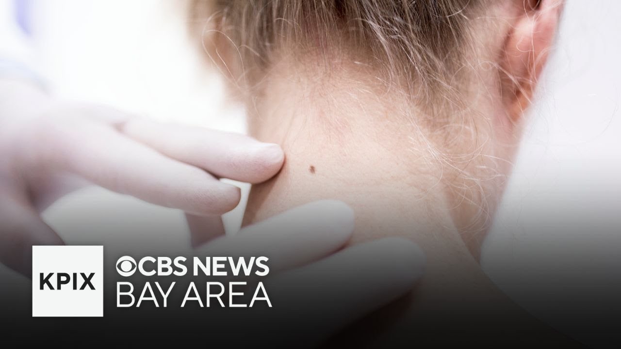 Stanford Treats First U.S. Cancer Patient Using Breakthrough Treatment for Melanoma Thumbnail
