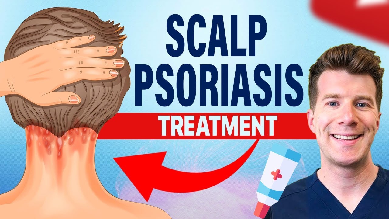 Doctor explains Four Treatments for Scalp Psoriasis Thumbnail