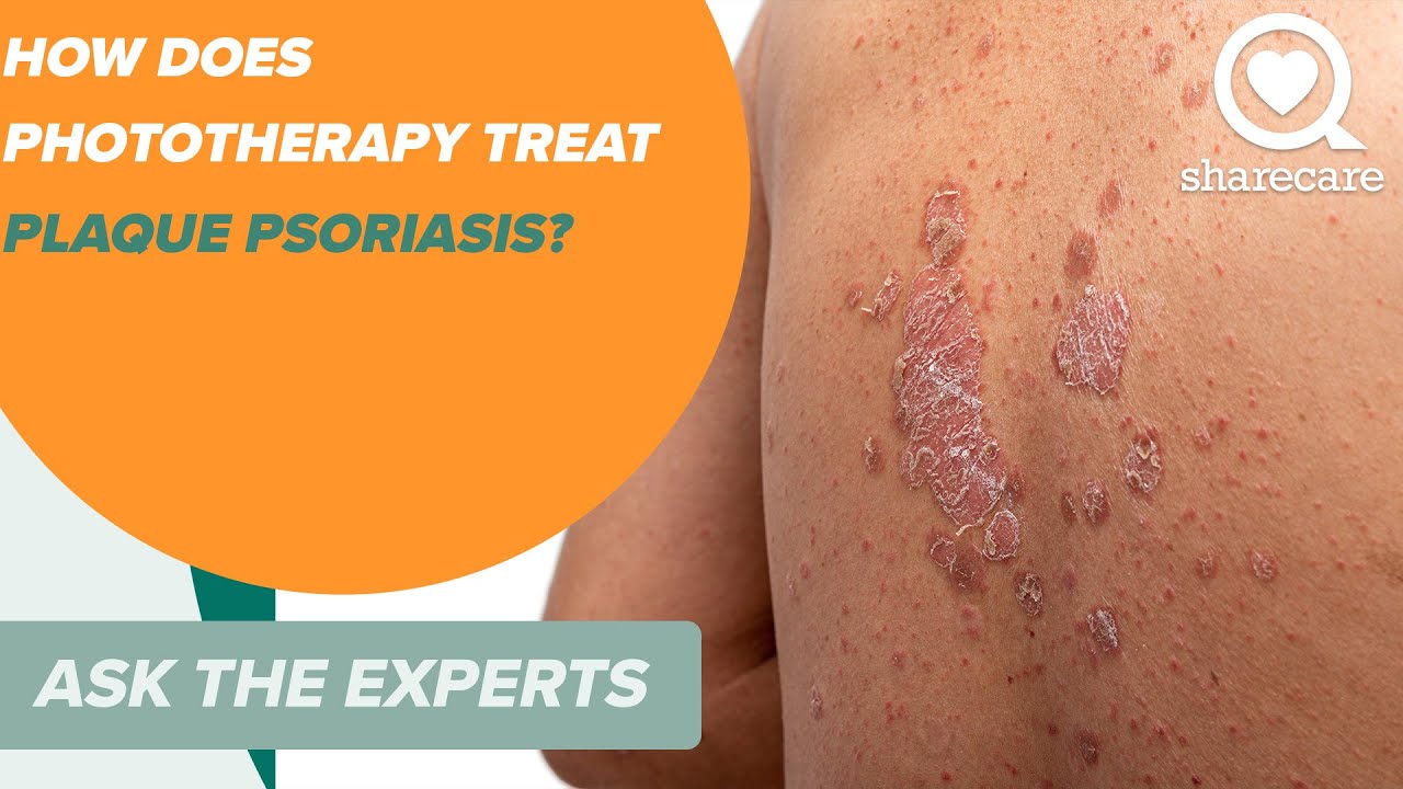 How Does Phototherapy Treat Plaque Psoriasis? | Ask the Experts | Sharecare Thumbnail