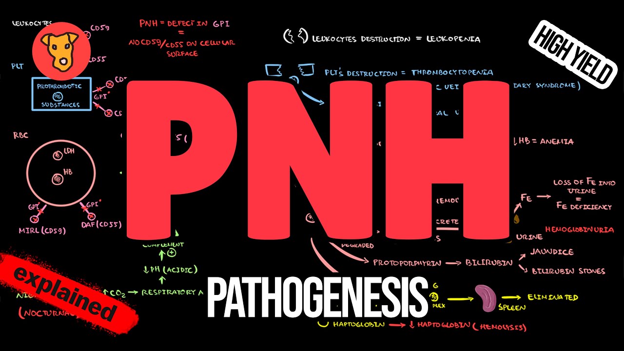 Paroxysmal Nocturnal Hemoglobinuria Pathogenesis Symptoms Diagnosis Treatment Thumbnail