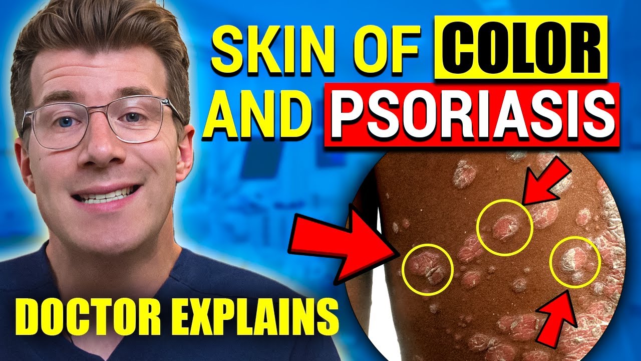 Skin of Color and Psoriasis: Visual Signs & Symptoms | Doctor Explains Thumbnail