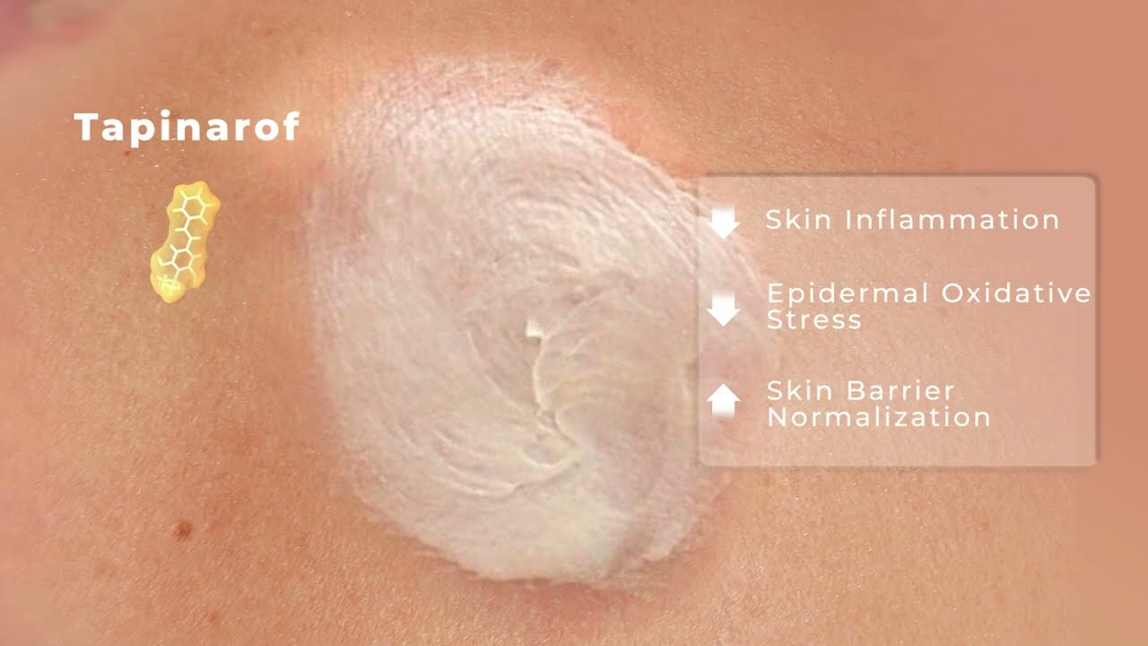 Tapinarof for Plaque Psoriasis – Mechanism of Action Thumbnail