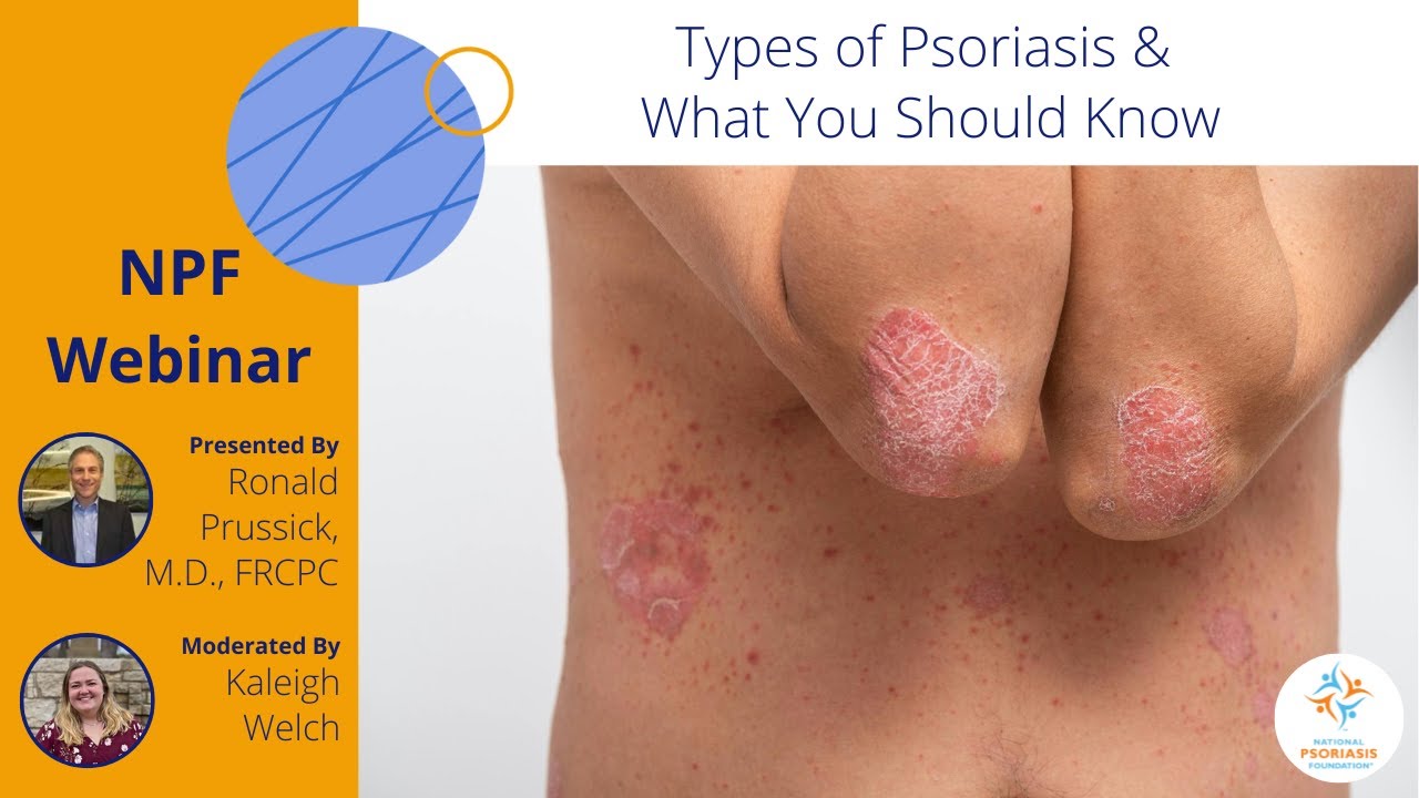 Types and Treatment for Psoriasis Thumbnail