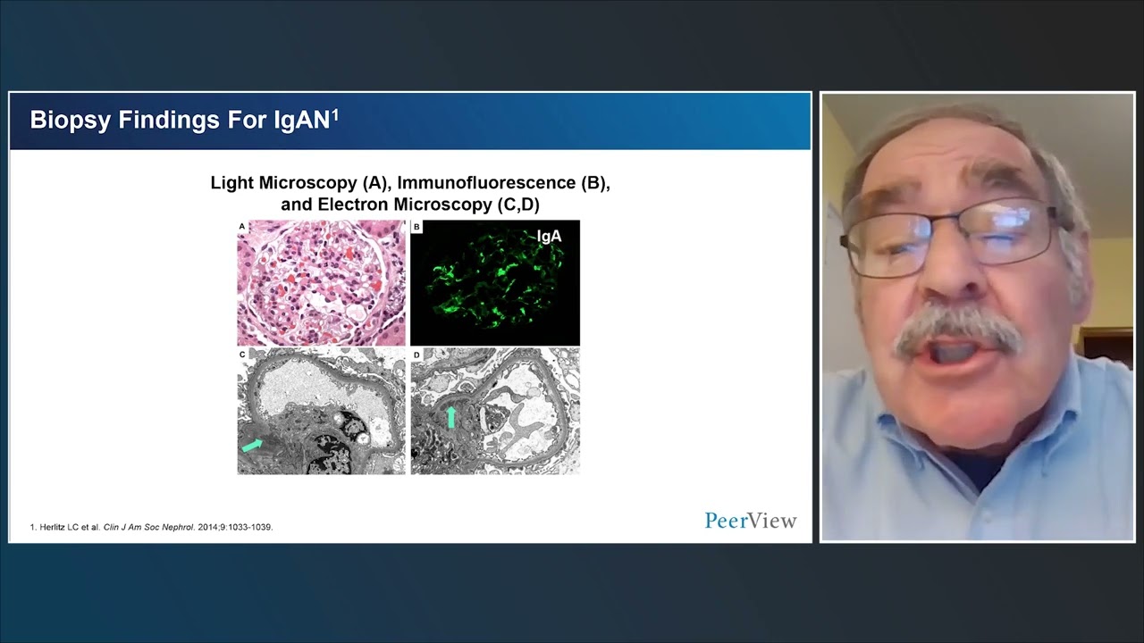 IgA Nephropathy Advancements Thumbnail