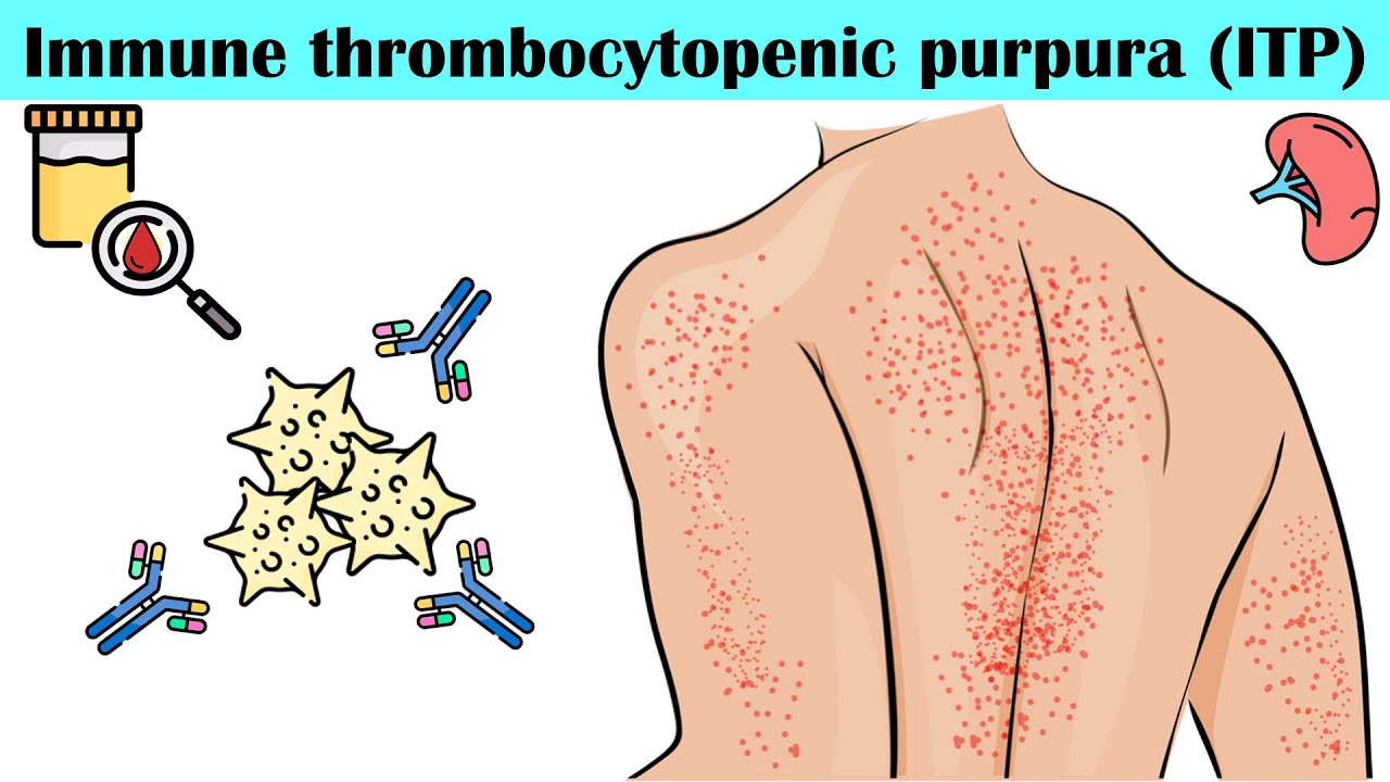 Immune Thrombocytopenic Purpura (ITP) – Causes, Pathogenesis, Signs & Symptoms, Diagnosis, Treatment Thumbnail