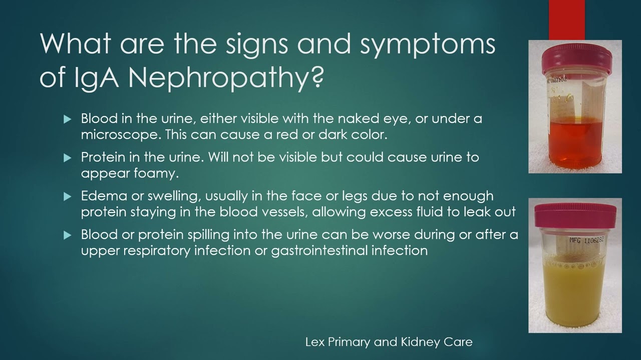 What Is IgA Nephropathy? Thumbnail