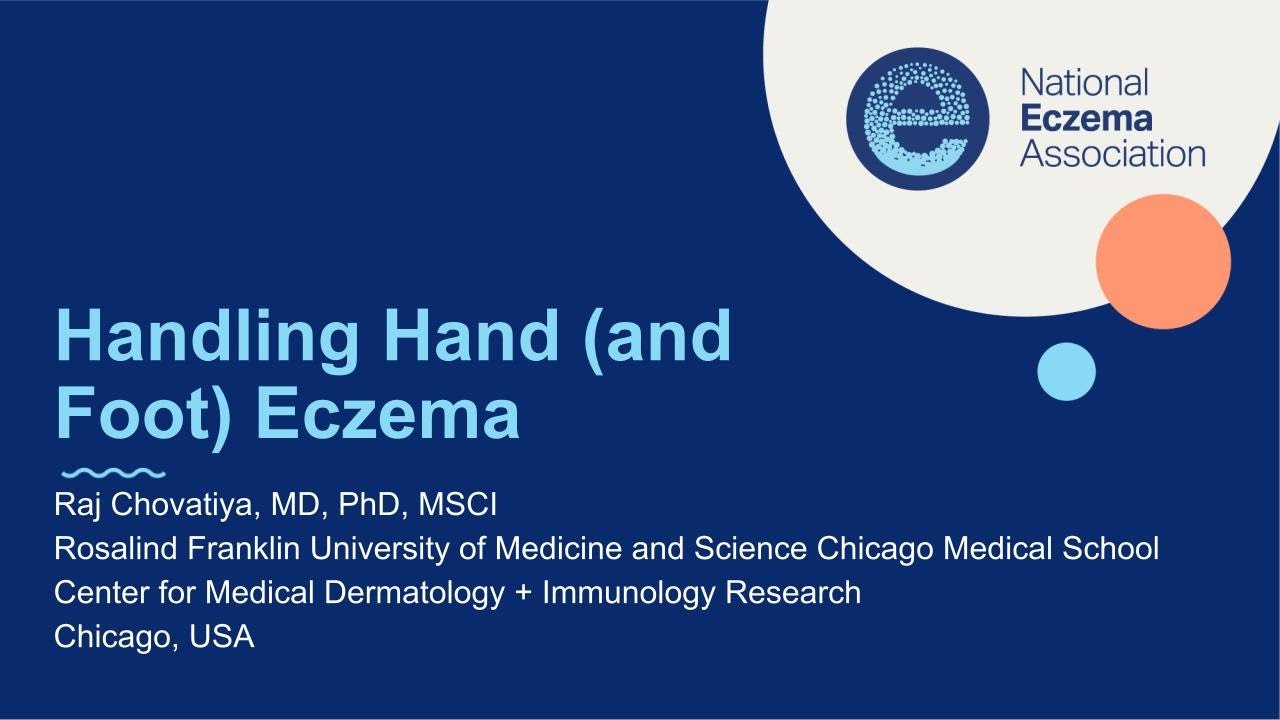 Handling Hand (and Foot) Eczema Thumbnail